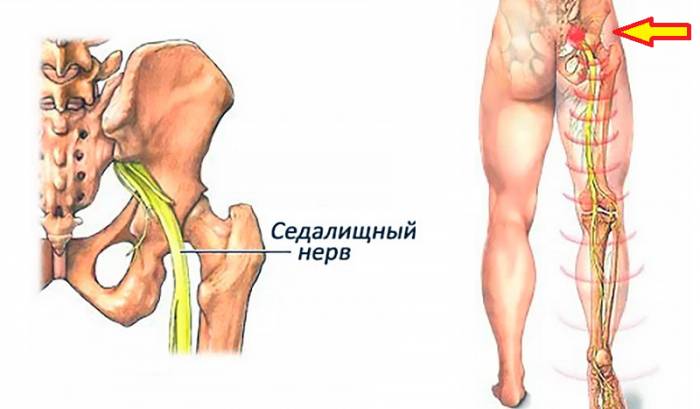 Зачастую ишиас или боли по ходу седалищного нерва – это хронизация пояснично-крестцового радикулита Зачастую ишиас или боли по ходу седалищного нерва – это хронизация пояснично-крестцового радикулита
