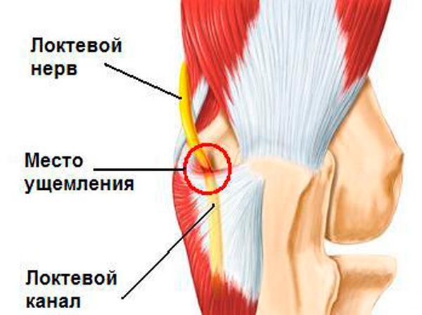 Защемление нерва в локтевом сочленении часто происходит по причине длительного сдавливания. Синдром длительного сдавливания.
