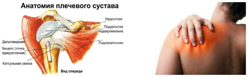 Защемление нерва в плече часто происходит по причине обострения хронических заболеваний суставов. Обострение хронических заболеваний суставов - вероятная причина патологии